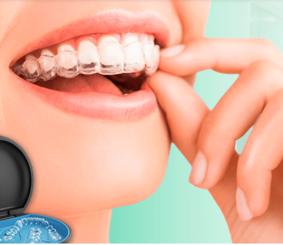 Niềng răng trong suốt Invisalign
