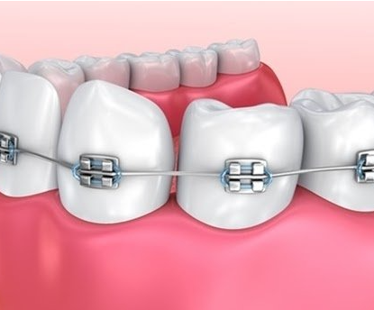 Niềng răng là gì - Lợi ích của niềng răng