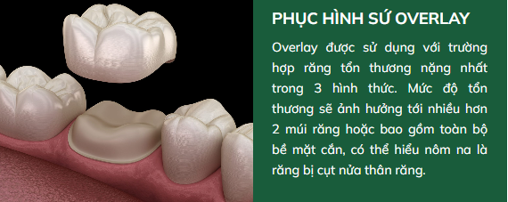 Phục hình sứ Inlay Onlay Overlay - vật liệu sứ