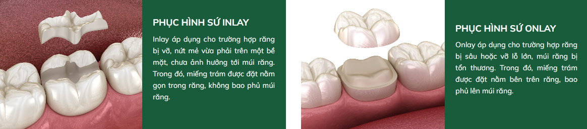 Phục hình sứ Inlay Onlay Overlay - vật liệu sứ