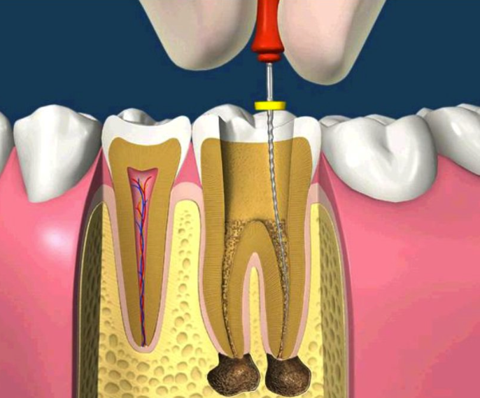 Điều trị tủy răng là gì
