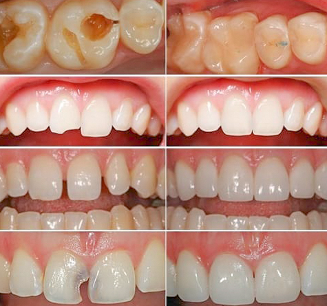 Hàn răng sữa trẻ em