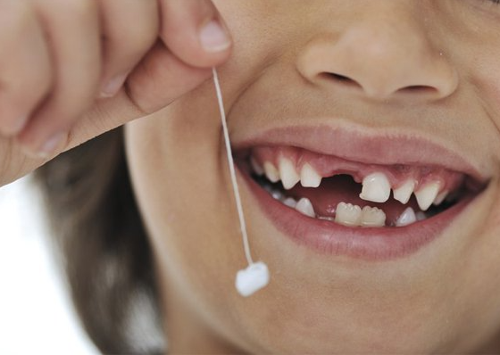 Nhổ răng sữa tại nha khoa