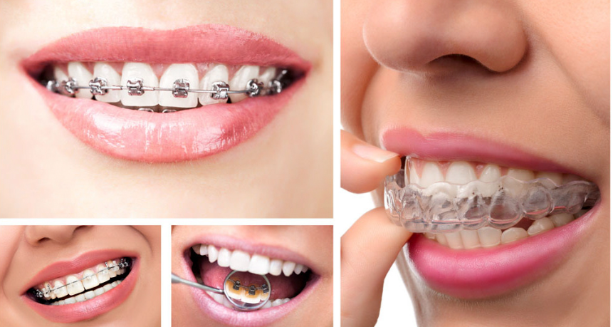 Các phương pháp niềng răng