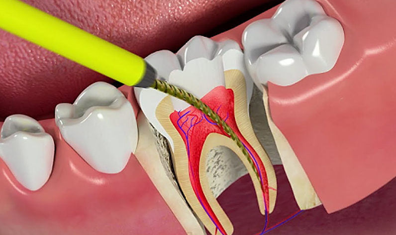 Quy trình điều trị tủy răng tại Nha Khoa Dr Hà