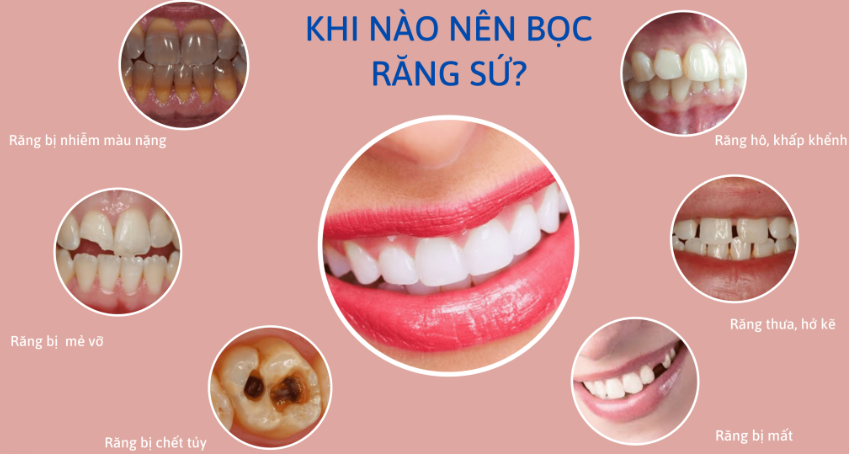 Răng sứ Katana - minh họa 2