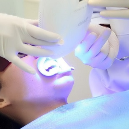 Tẩy trắng răng tại nha khoa