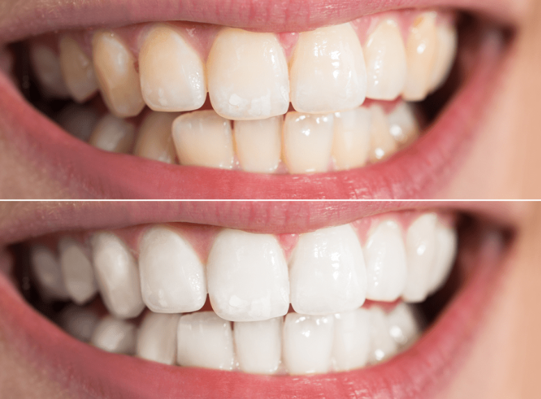 Tẩy trắng răng tại nhà