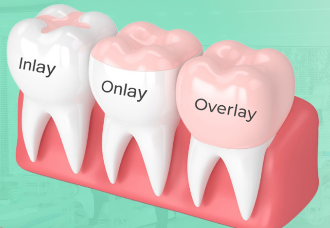 Các loại Inlay Onlay Overlay